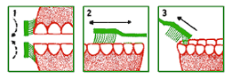 Caries, ¿Qué pasa cuando la caries ataca?