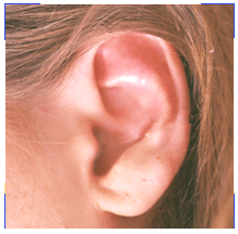 otitis_0